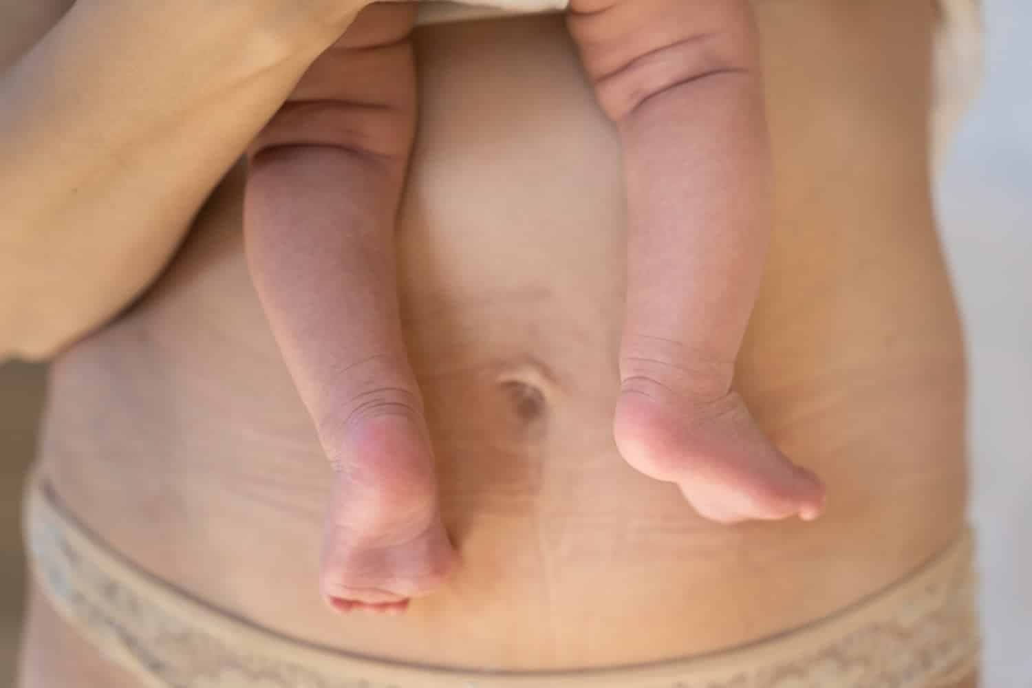 Can You Get Stretch Marks From Losing Weight? Pregnancy And Childbirth Questions