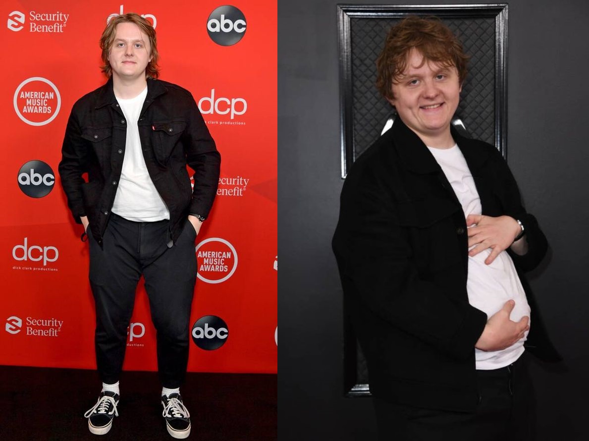 lewis capaldi before and after.1jpg